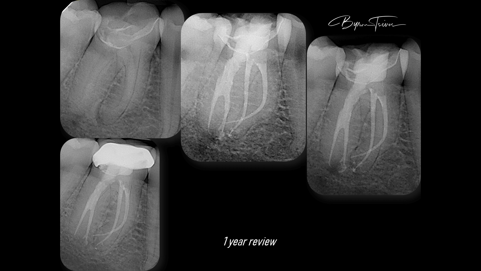 Broken Instrument Removal - Case 6